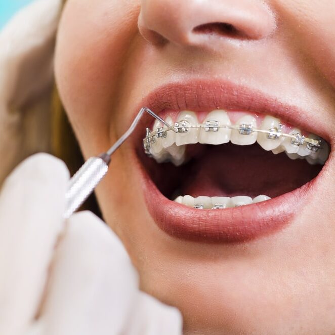 Orthodontic Treatment in Coimbatore