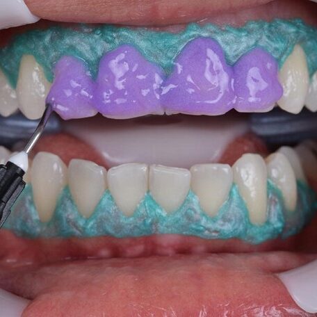 Teeth Whitening treatment procedures