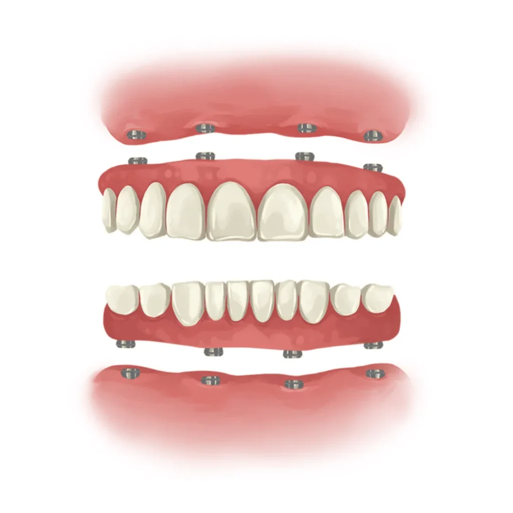 Full Mouth Rehabilitation treatment in coimbatore