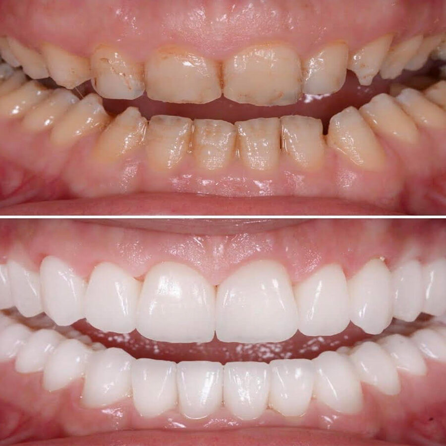 Full Mouth Rehabilitation Treatment in Coimbatore