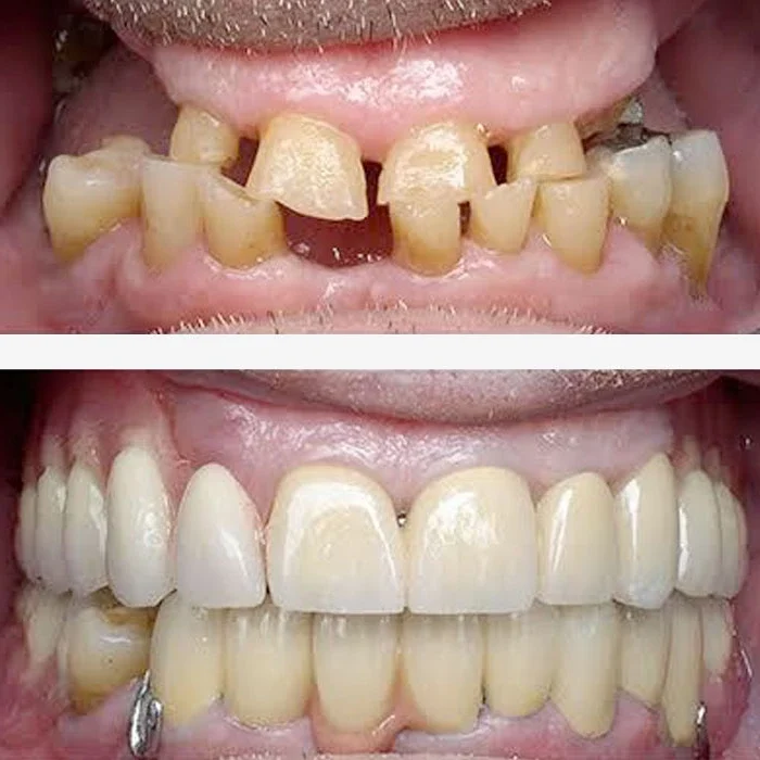 Teeth Restoration Treatment in Coimbatore