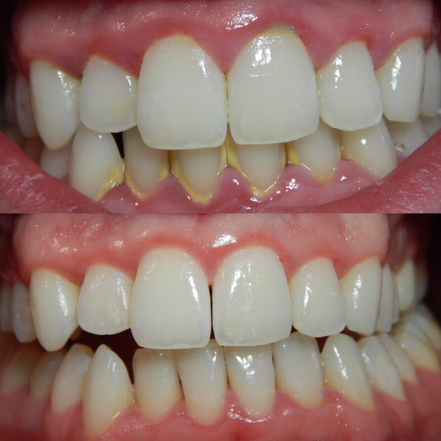 Dental Ultrasonic Scaling Treatment in Coimbatore