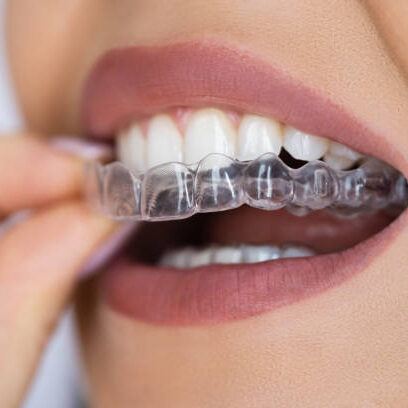 Orthodontic Treatment in Coimbatore