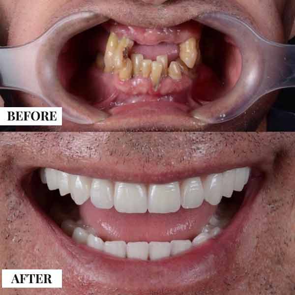 Full Mouth Rehabilitation Treatment in Coimbatore