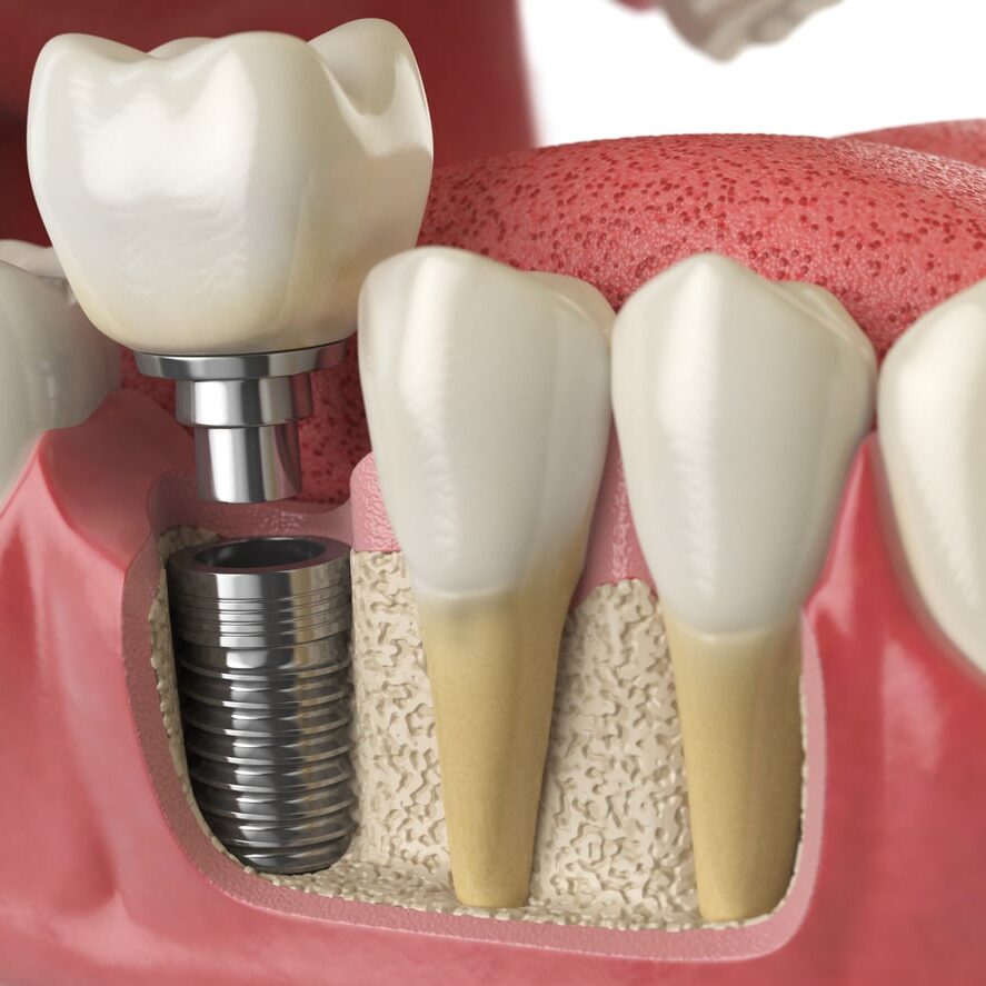 Dental Implant Treatment in Coimbatore