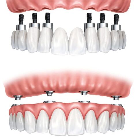 Teeth Restoration Treatment in Coimbatore