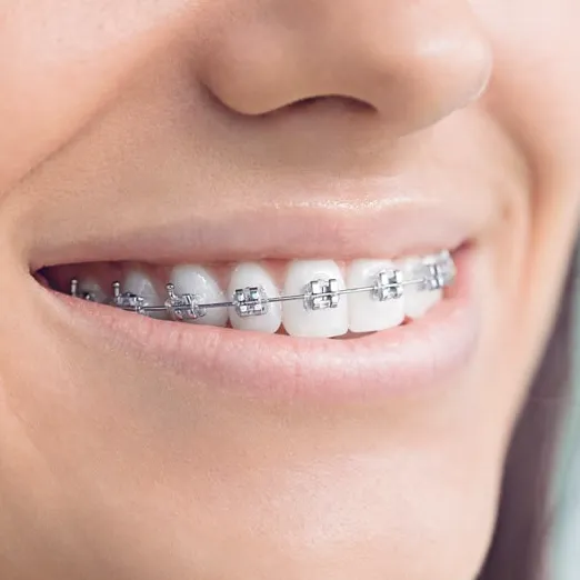 Orthodontic Treatment in Coimbatore
