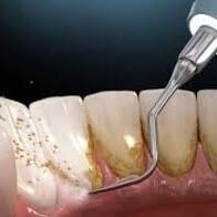 Dental Ultrasonic Scaling Treatment in Coimbatore