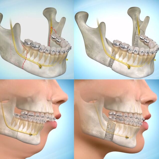 Orthodontic Treatment in Coimbatore