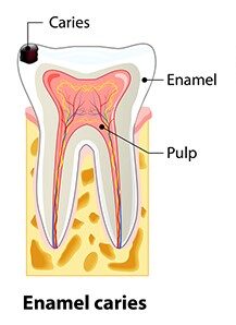Root Canal treatment Cost in Coimbatore