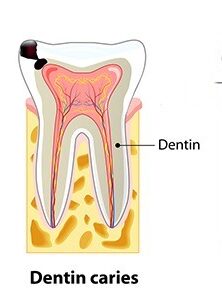 Root Canal Treatment Procedure