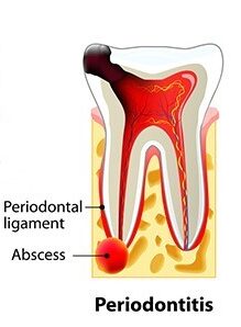 Root Canal Treatment cost in Coimbatore