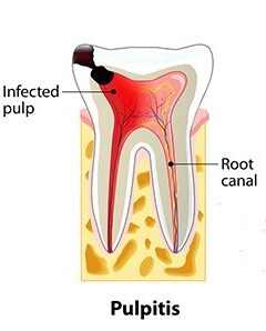 Root Canal Treatment procedure