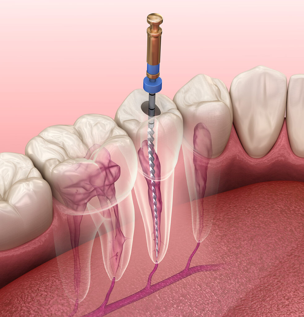 Root Canal Treatment In Coimbatore