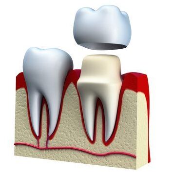 Dental Crowns treatment cost