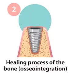 Dental Implants treatment in coimbatore