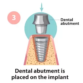 Dental Implants treatment in coimbatore
