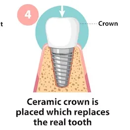Dental Implants treatment in coimbatore