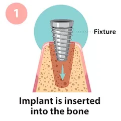 Dental Implants treatment in coimbatore