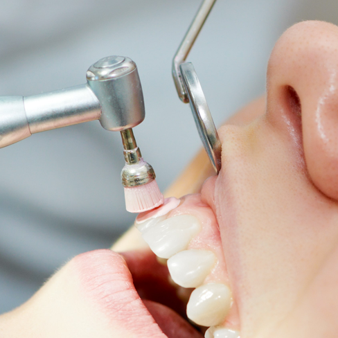 Dental Ultrasonic Scaling Treatment in Coimbatore